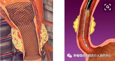 食道癌晚期介入治疗,山西肿瘤医院介入科食管癌