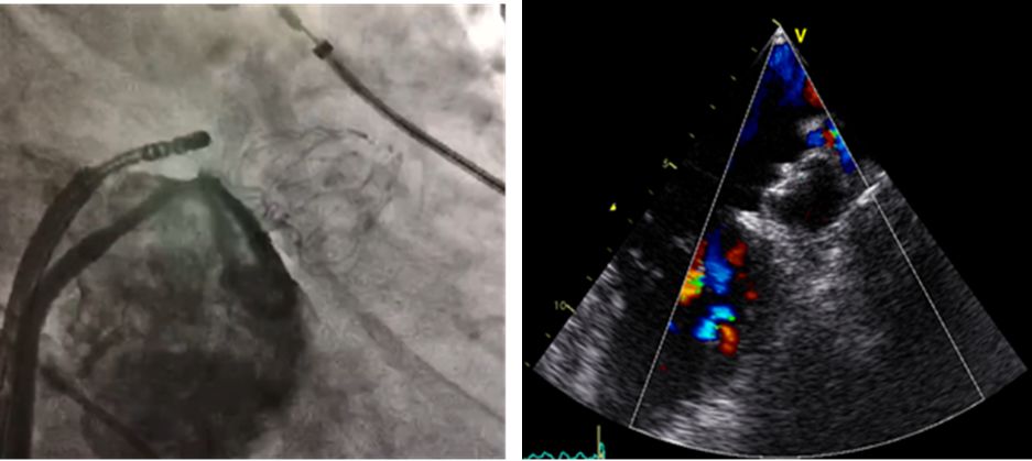 治房颤新技术叫什么,治房颤的应急中成药