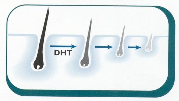 5个原因导致男人脱发,雄激素性脱发能治吗