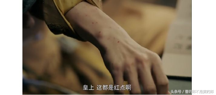 延禧攻略中聂远得疥疮,延禧攻略皇上得疥疮的原因