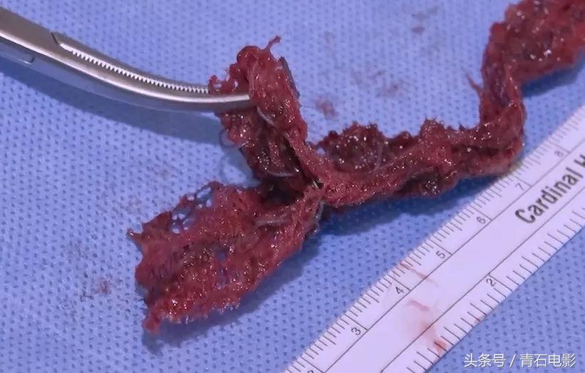 网飞出品的纪录片，上映后让美公司停售一款尖端医疗器械！