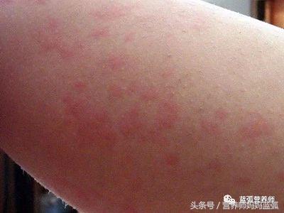 每5个人就有1个患寻麻疹，这样调理才能治本！