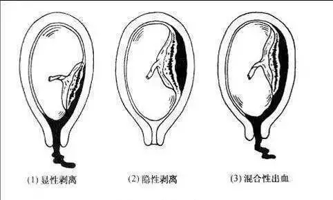 怀孕8个多月胎死腹中的征兆,怀孕八个月胎死腹中是怎么了