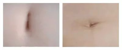 肚脐长得难看怎么办,肚脐长得很长怎么办