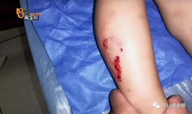 7岁男童被狗咬狂犬病发作死亡,狗咬伤小孩打狂犬疫苗后死亡