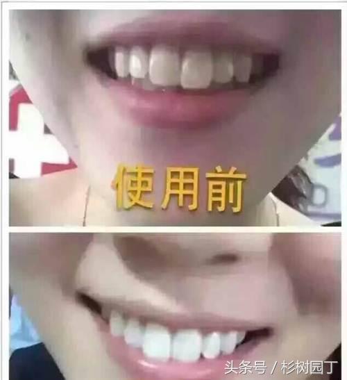 美牙仪真的有用吗骗人的吗,美牙仪是有线的好还是无线的好