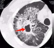 患结核的帅小哥很憋屈:4个月没牵女朋友的手,我现在还传染吗?