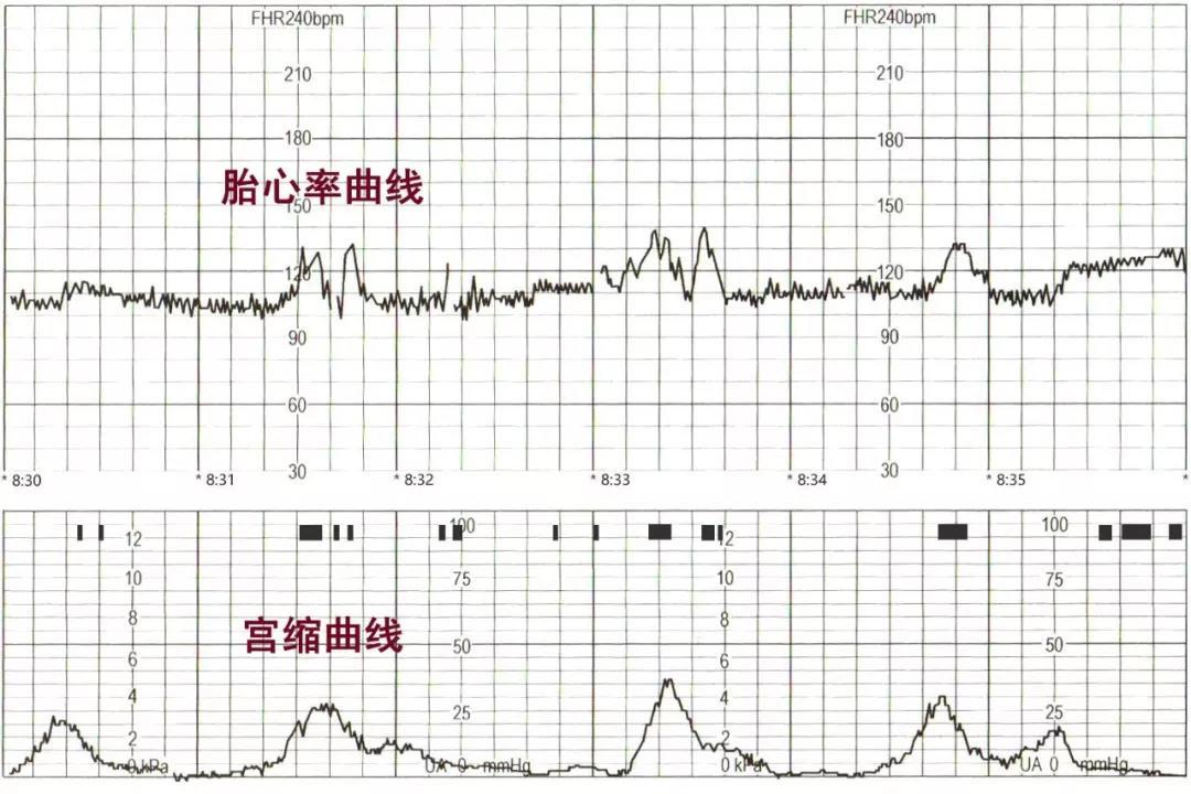 肚皮薄导致宫缩频繁怎么办,孕后期肚子发紧是宫缩吗
