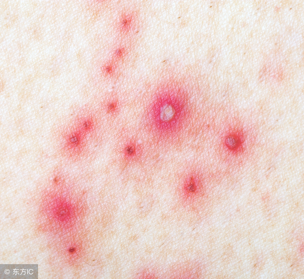 病毒性疱疹是怎么传染的呢？有哪些注意事项