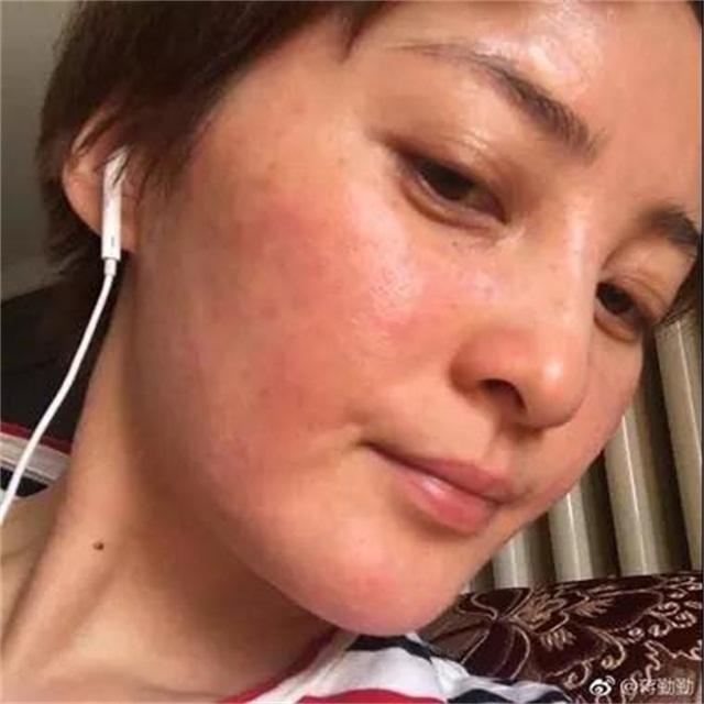 脸部松弛有细纹粗糙怎么办,蒋勤勤敏感肌肤怎么消除