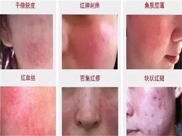 脸部松弛有细纹粗糙怎么办,蒋勤勤敏感肌肤怎么消除