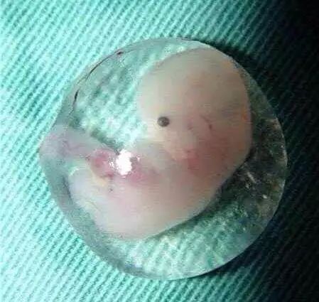 宫外孕患者需要注意什么事项,宫外孕要和长辈说吗