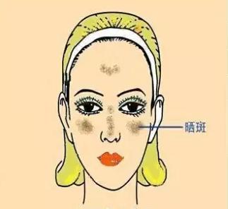 如何识别各种不同的斑,不同位置的色斑叫什么