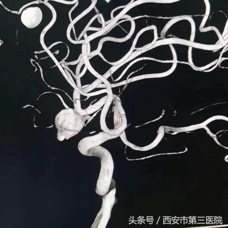 脑袋里有气球膨胀的感觉,脑袋里气球爆炸的声音