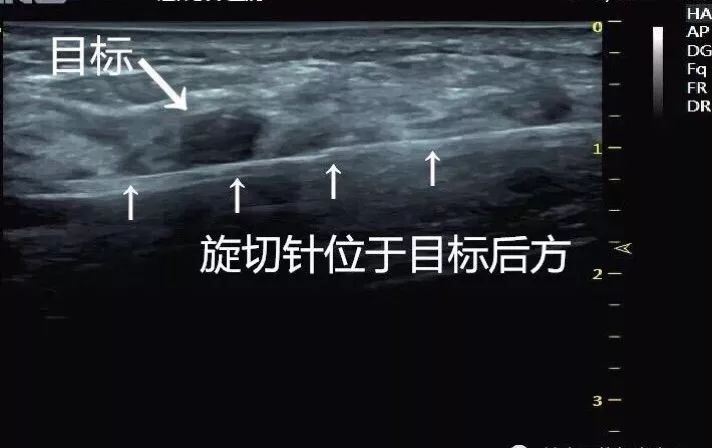 徐州哪个医院做乳腺微创手术最好,医大一院乳腺微创手术谁做的好