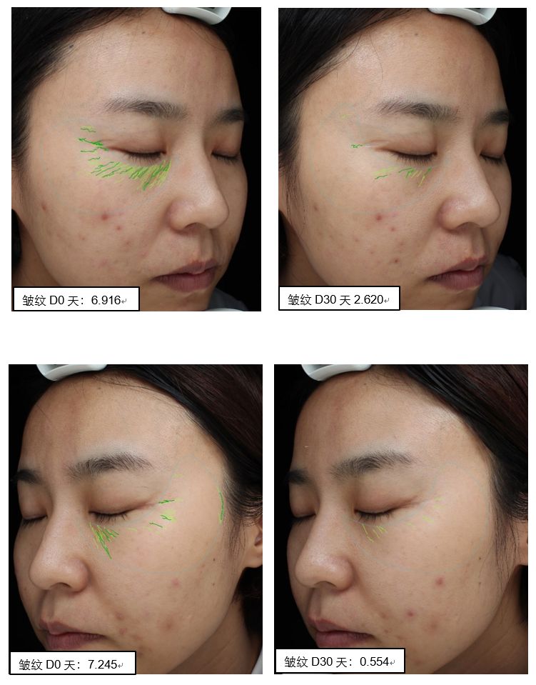 菲洛嘉十全大补面膜用了之后爆痘,十全大补面膜菲洛嘉值得购买吗