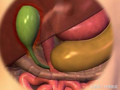 舒卿胆囊炎胆结石针灸视频,董氏针灸治疗胆囊炎特效穴位