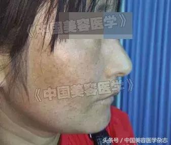 中药调理褐斑一般多久能见效,中药和针灸调理黄褐斑