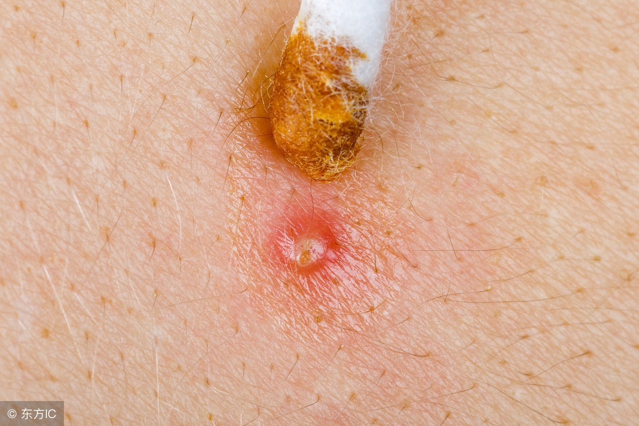 急性毛囊炎怎么引起的,一般毛囊炎是什么原因引起的