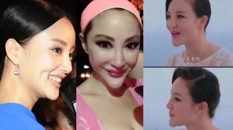 下巴填充和假体植入哪个好,下巴填充膨体跟硅胶哪个更好