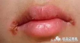 烂嘴角的饮食注意事项,烂嘴角怎么调理