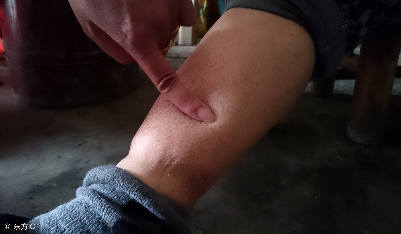 孕妇怀孕几个月会出现水肿,孕妇孕几个月开始会水肿