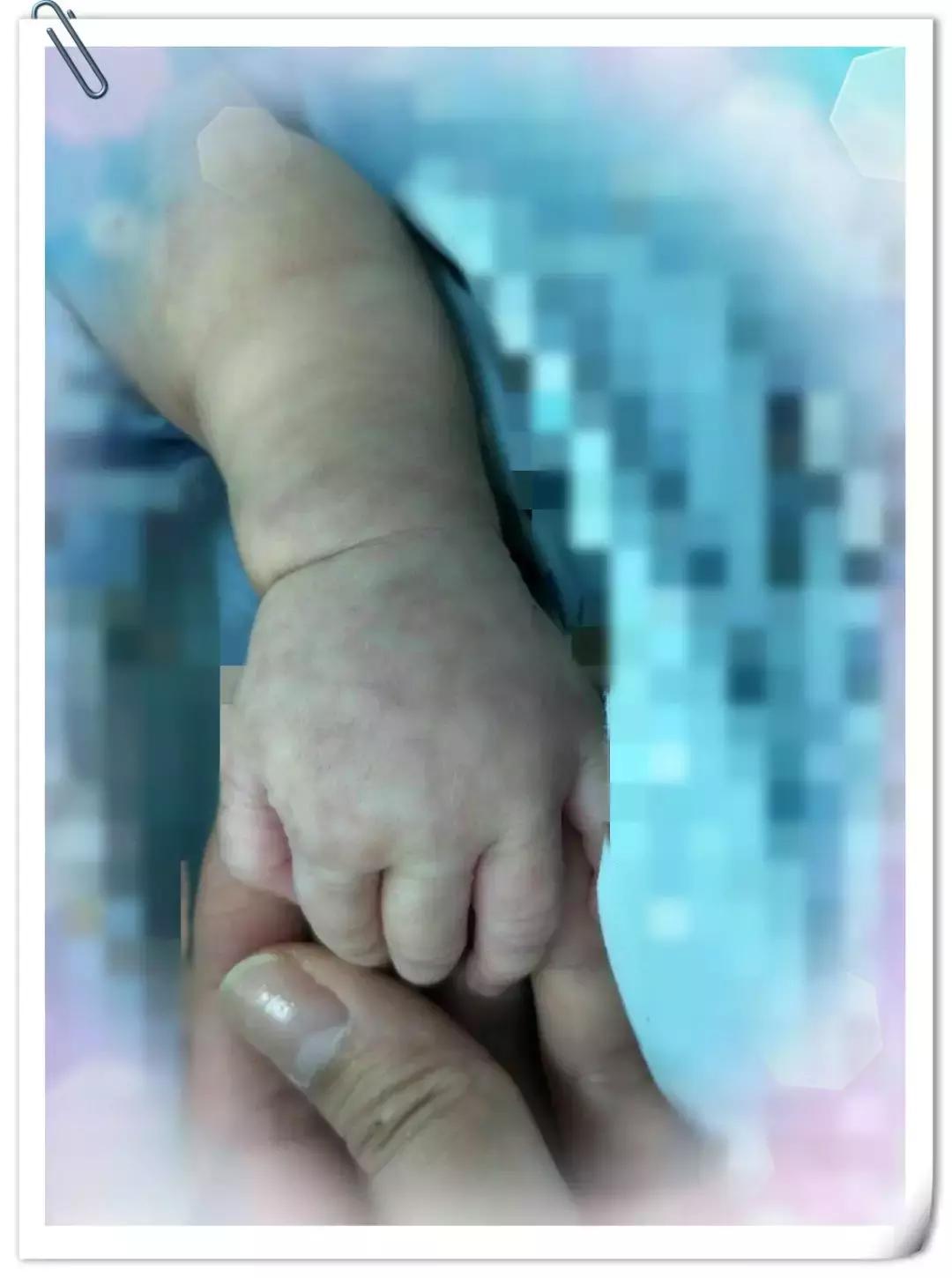 手背上有花斑的图片,手背上有褐色花斑是怎么回事