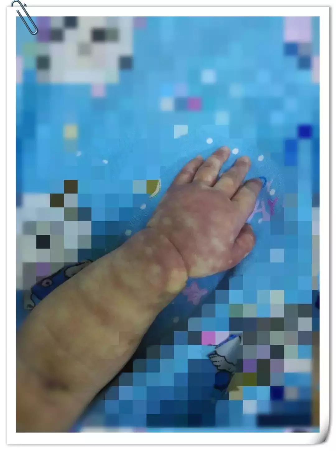 手背上有花斑的图片,手背上有褐色花斑是怎么回事