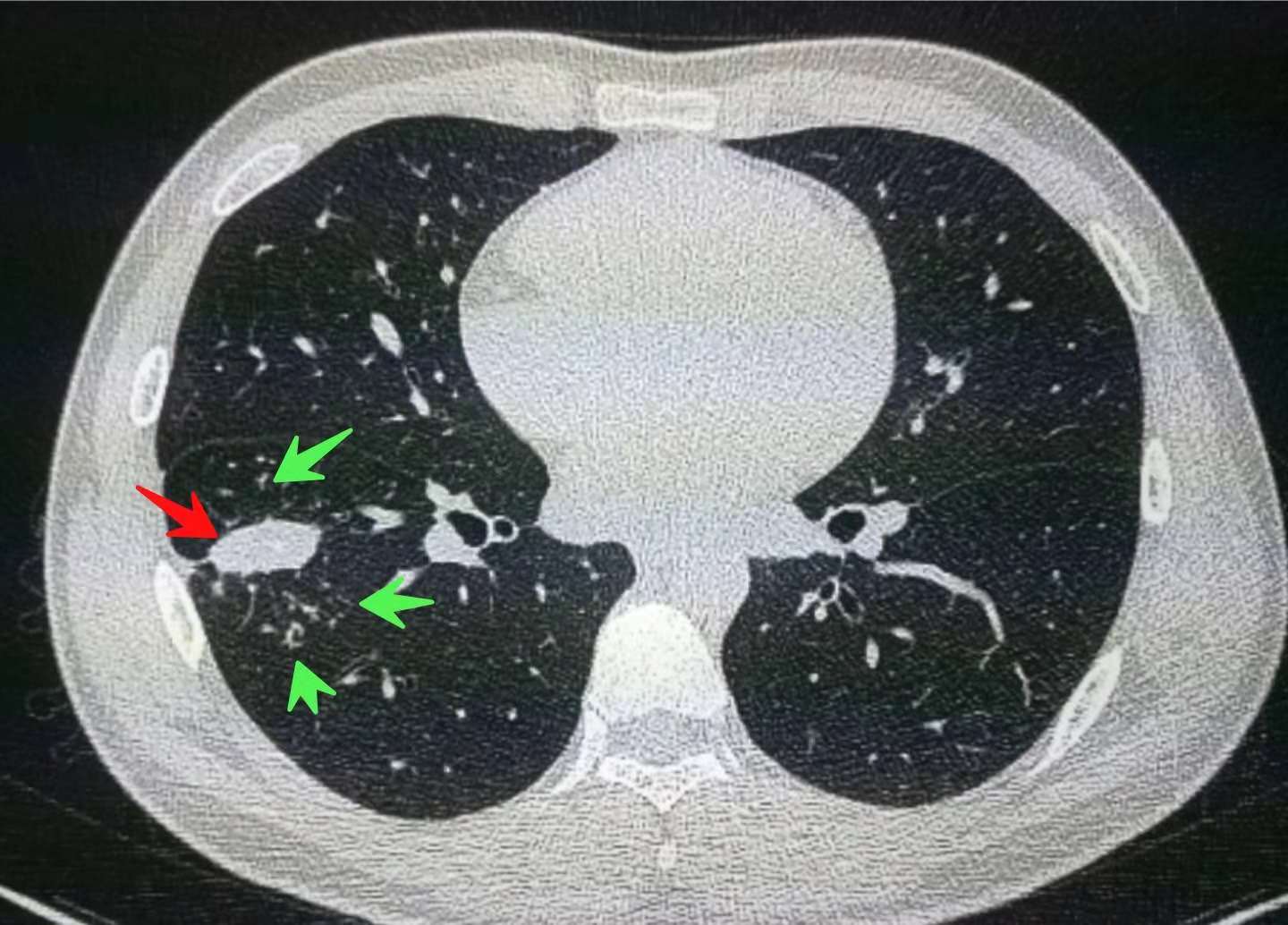 晚期肺癌6年后肿瘤缩小两倍,他的秘诀:放化疗+地图+敬老院+偏方