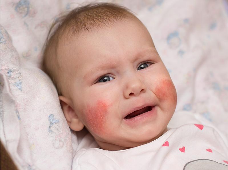 宝宝脸上有红疹怎么处理,婴儿脸上起红疹子发痒怎么办