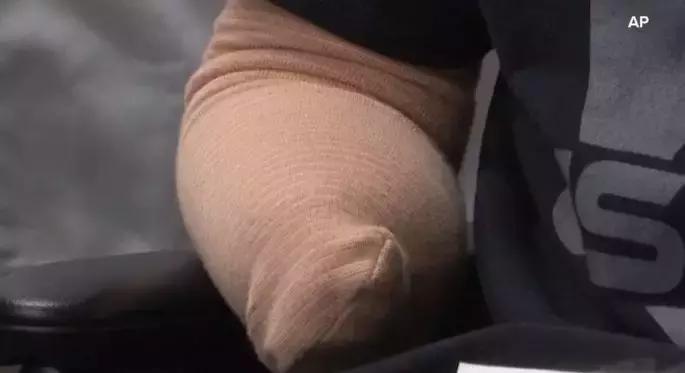 又一例！他严重感染四肢被截，竟只因被狗狗舔了一下……