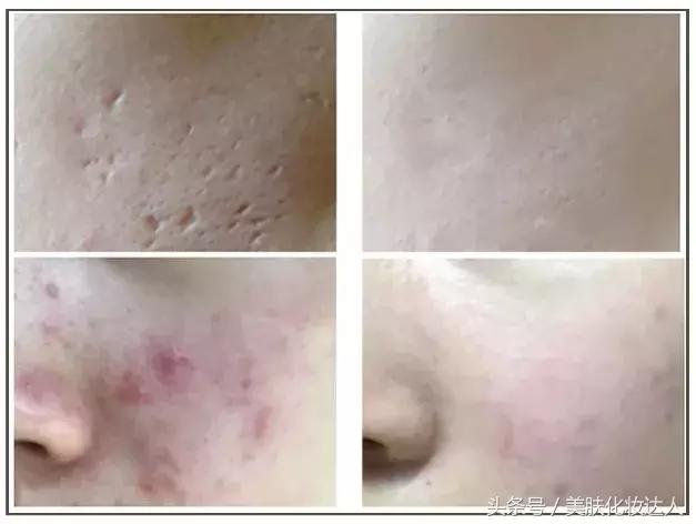 烂脸救星医美面膜到底能不能用,医美面膜和其他面膜有什么区别