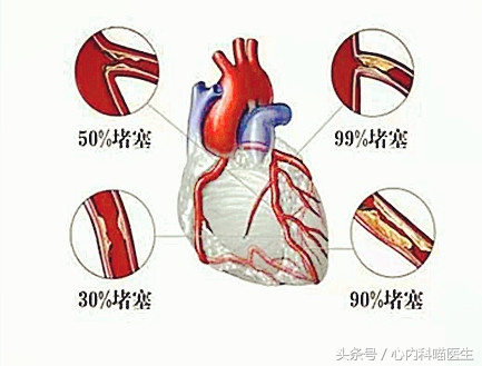 长期药物治疗可以减轻冠状动脉狭窄、减少心绞痛和心梗发生