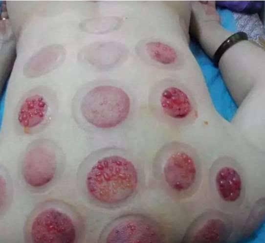 拔罐时出现罐印红是怎么回事,拔罐后的罐印对照表