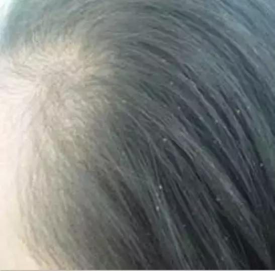12岁女生头皮屑多什么原因,12岁女孩头皮屑超多是什么原因