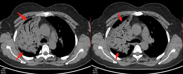 13岁女孩咳嗽半个月确定肺癌,咳嗽一个多月肺癌还有救吗