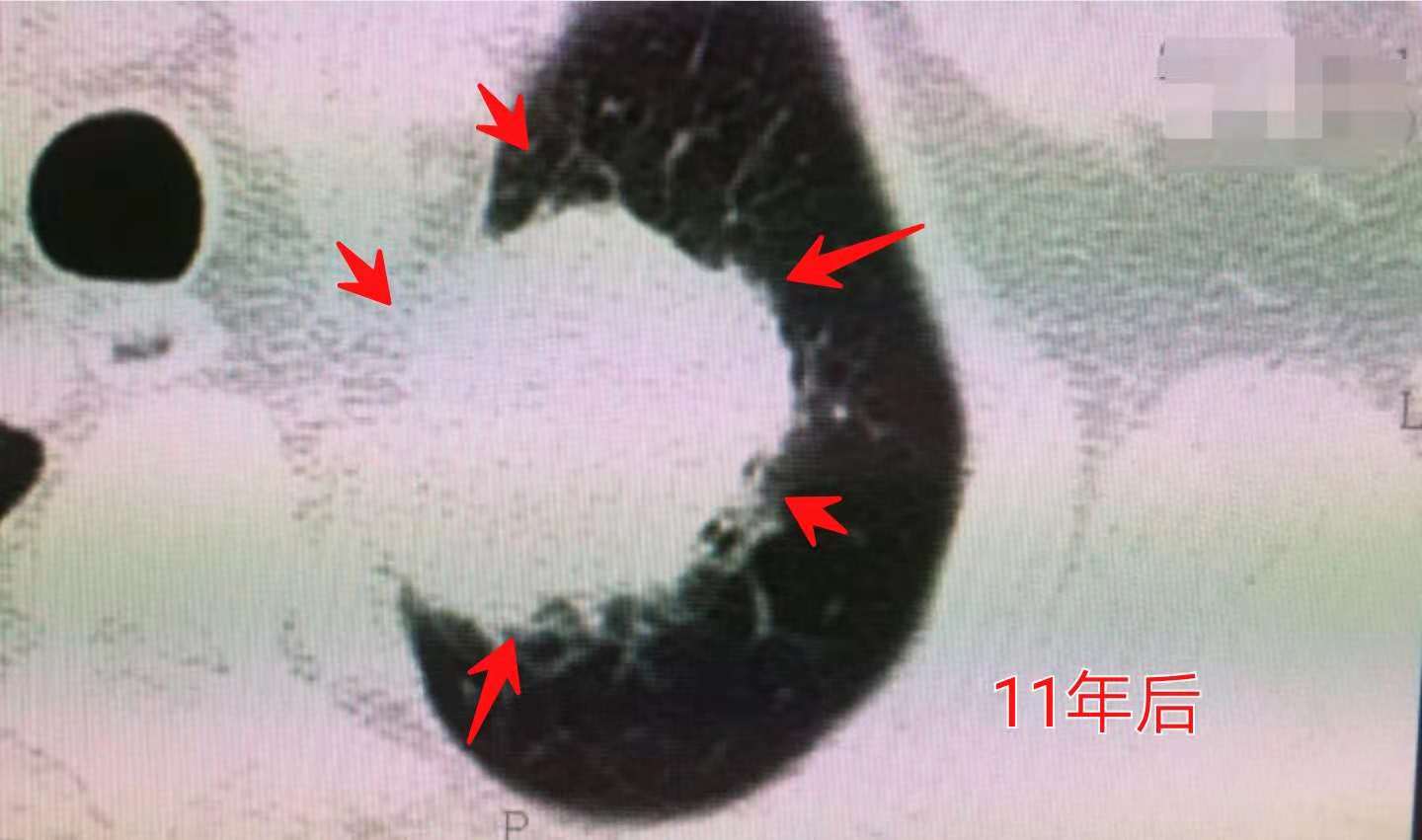 13岁女孩咳嗽半个月确定肺癌,咳嗽一个多月肺癌还有救吗