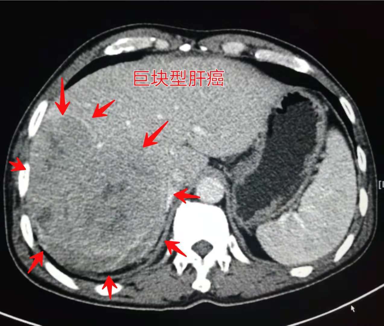 13岁女孩咳嗽半个月确定肺癌,咳嗽一个多月肺癌还有救吗