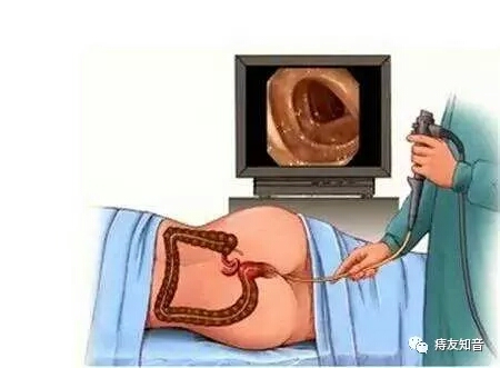 肠镜检查前该做哪些准备工作,做肠镜检查前做什么准备工资高