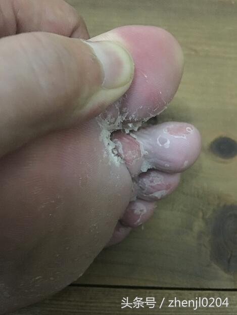 晚间脚气知识科普,科普脚气小知识