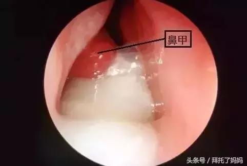 清鼻涕浓稠,清鼻涕小妙招婴儿