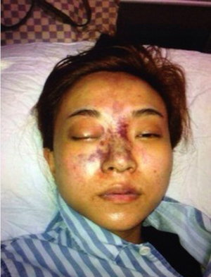 注射玻尿酸的危害图片,注射玻尿酸有害吗