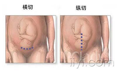 剖腹产,剖腹产3d动画演示