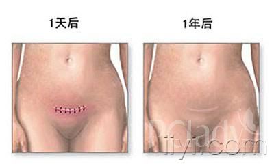 剖腹产的麻醉针,剖腹产最多可以剖几次