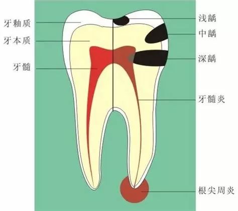 蛀牙三颗算多吗,蛀牙是怎么吃掉牙齿的