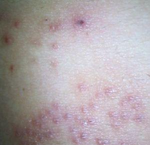 儿童得了疥疮怎么用药,治疗疥疮有泡澡用药吗