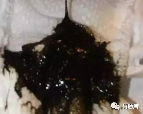 直肠癌内痔可以误诊吗,直肠癌误诊为痔疮的原因是什么