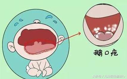 宝宝鹅口疮和口腔溃疡怎么分辨,小儿鹅口疮症状病因及治疗