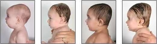 左边扁头偏头怎么睡矫正,先纠正扁头还是偏头