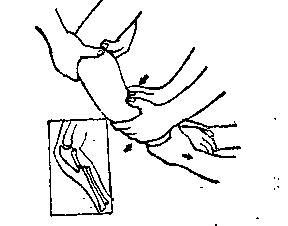 中医骨折治疗原则,中医骨伤整复术